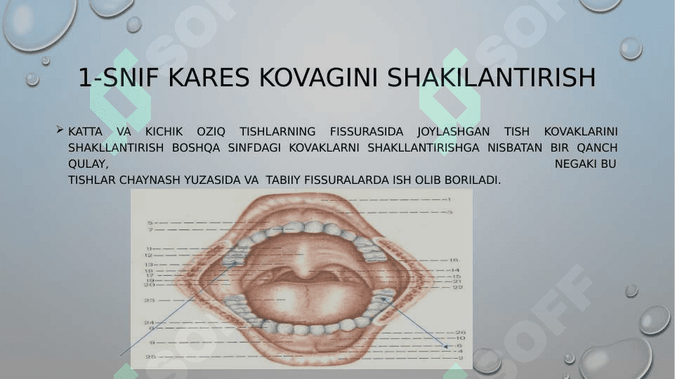 ko’r teshiklarda  joylashgan 1-sinif karest kovagini  charxlashni o'ziga hosligi 2