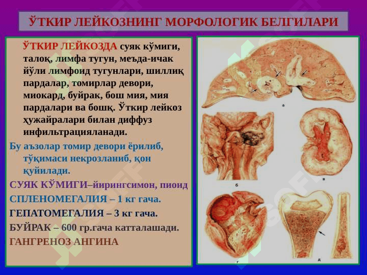 Leykoz Anemiya ppt 5