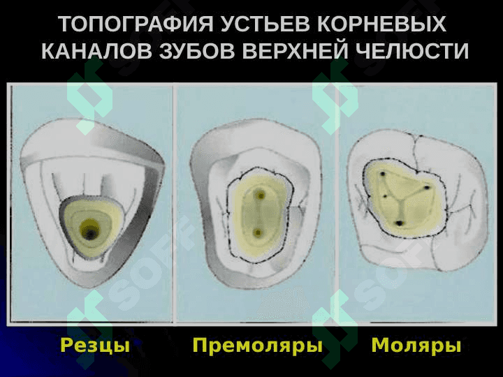 Механическая обработка корневых каналов 3