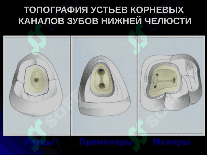 Механическая обработка корневых каналов 4