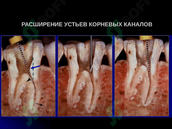 Механическая обработка корневых каналов 7