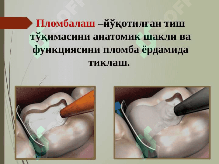Пломба ашёларининг таснифи. Таркиби, хусусиятлари, кўллашга кўрсатмалар 2