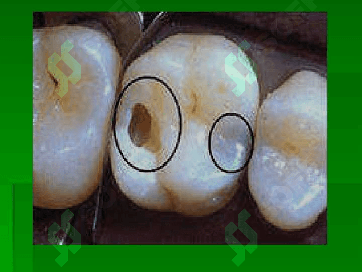 Kariyes , pulpit, periodontit 2