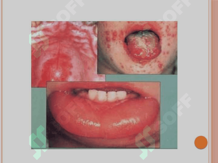 Stomatologiyada Allergiya, Anafilaktik shok, kollaps, hushdan ketish klinikasi, davolash 3
