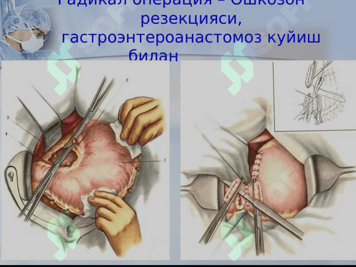 Xirurgik operatsiyalar 7