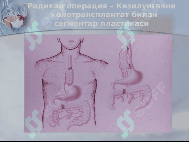 Xirurgik operatsiyalar 8