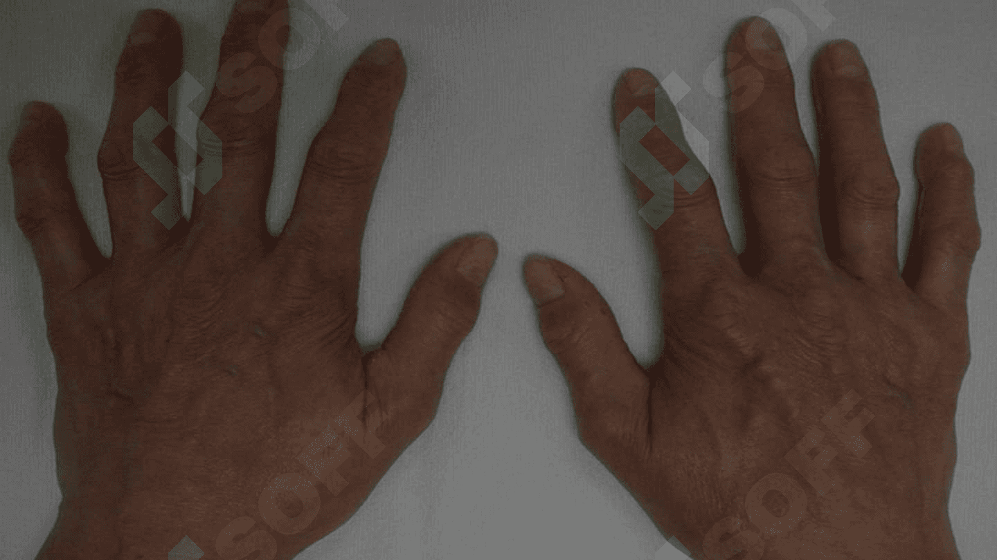 SKLERODERMIYA.DERMATOMIOZIT. DERMATOVNEROLOGIYA 4