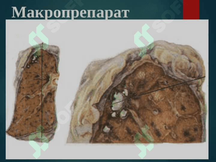 O`PKANING O`CHOQLI YALLIG`LANGAN TUBERKULOZI VA O`PKA TUBERKULEMASI 7