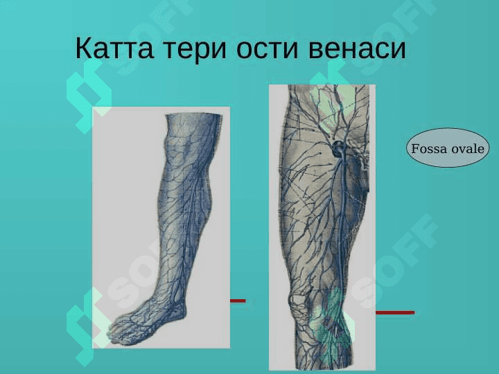 Oyoq venalarining varikoz kasalligi 7