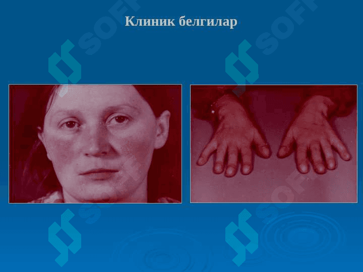 Orttirilgan yurak nuqsonlari . Орттирилган юрак нуқсонлари 2