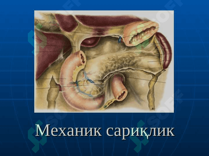 Mexanik sariqlik . Mexanik sariqliklar 2