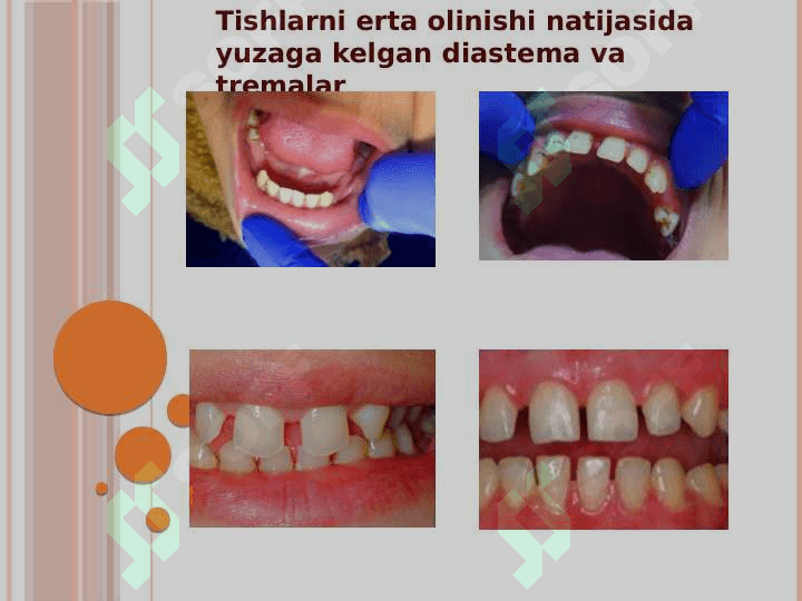 TISHLARNI ERTA OLINISHI NATIJASIDA YUZAGA        KELISHI MUMKIN BO’LGAN ASORATLAR 4