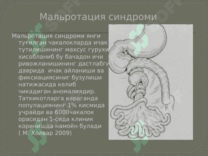 Malrotatsiya sindromi . Мальротация синдроми 5