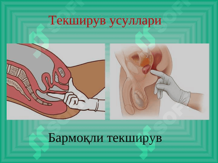 Yog`on va to`g`ri ichak hirurgik kasalliklari .  Йўғон ва тўғри ичак хирургик касалликлари 8