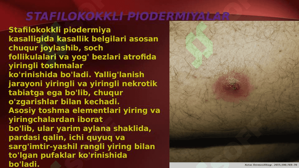 Terining yiringli kasalliklari . Piodermiyalarni umumiy kechishi . Stafilodermiyalar , oddiy husnbuzar . Streptodermiyalar . Bolalarda uchraydigan stafilodermiyalar . Piodermiyalarni davolash 5