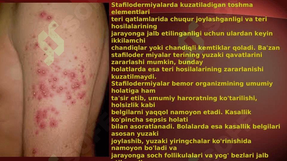 Terining yiringli kasalliklari . Piodermiyalarni umumiy kechishi . Stafilodermiyalar , oddiy husnbuzar . Streptodermiyalar . Bolalarda uchraydigan stafilodermiyalar . Piodermiyalarni davolash 6
