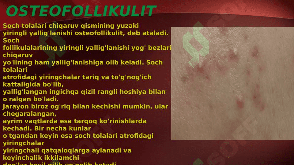 Terining yiringli kasalliklari . Piodermiyalarni umumiy kechishi . Stafilodermiyalar , oddiy husnbuzar . Streptodermiyalar . Bolalarda uchraydigan stafilodermiyalar . Piodermiyalarni davolash 8