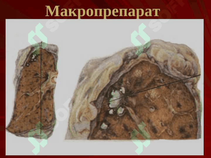 O`pkaning o`choqli , yalliglangan tuberkulyozi va o`pka tuberkulomasi 7