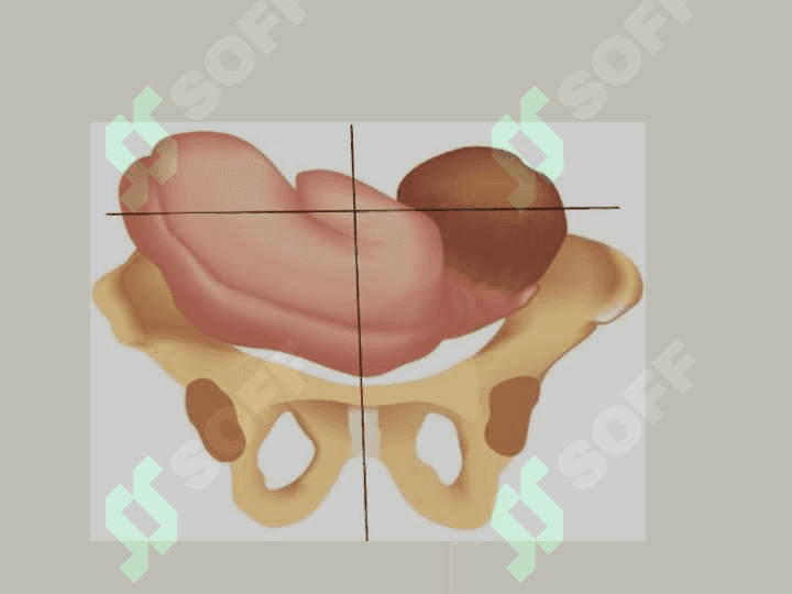 НЕПРАВИЛЬНЫЕ ПОЛОЖЕНИЯ ПЛОДА 5