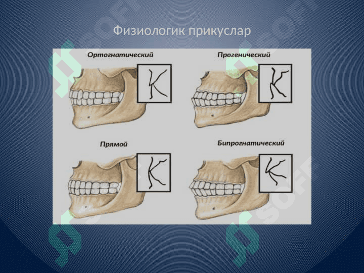 Prikus va tish taraqqiyotida          uchraydigan anomaliyalar 5