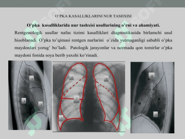 Ko'krak qafasi rentgenografiyasi.O'pka kasalliklarida nur tashxisi. 2