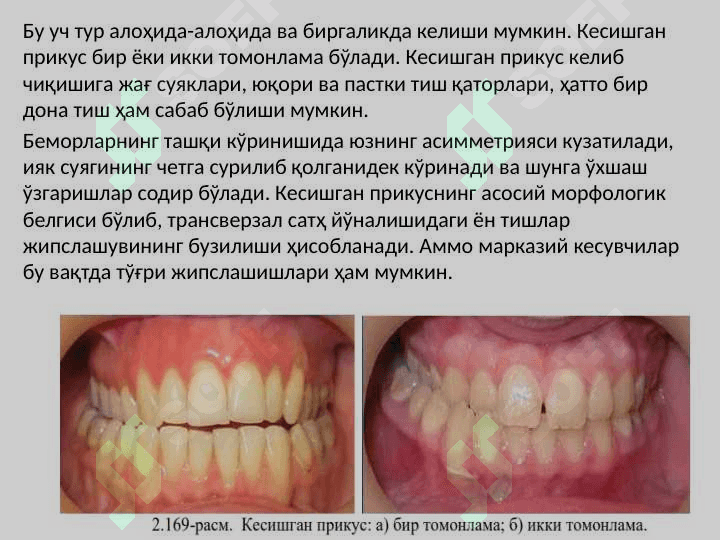 Kesishgan prikus 4