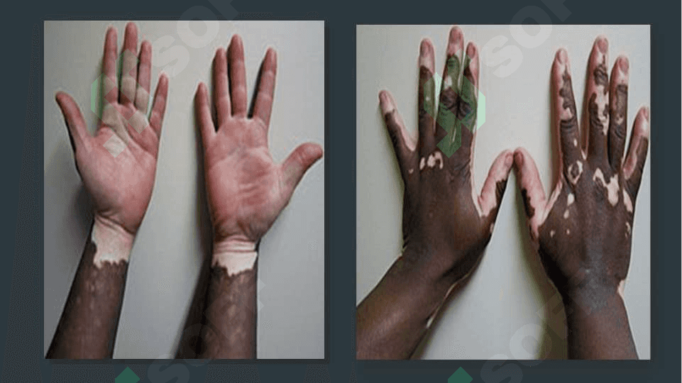 VITILIGO VA UNING ZAMONAVIY DAVOLASH USULLARI 5