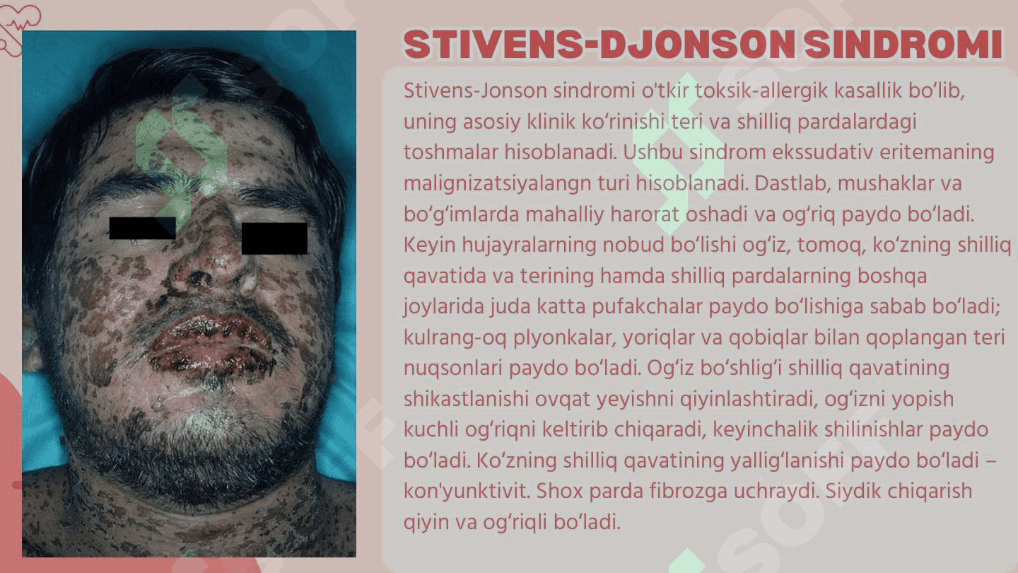 STIVENS-DJONSON VA LAYELL SINDROMLARI 2