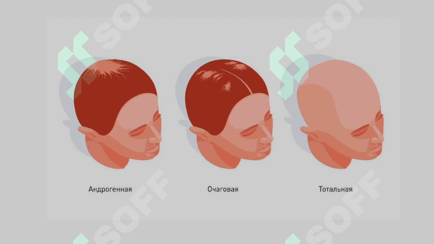 ALOPESIYANING ZAMONAVIY DAVOLASH USULLARI 5
