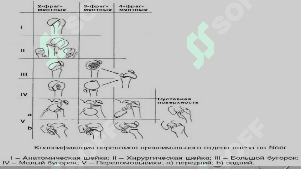 Yelka suyaklarining sinishlari va yelka suyakgi boshchasini chiqish 4