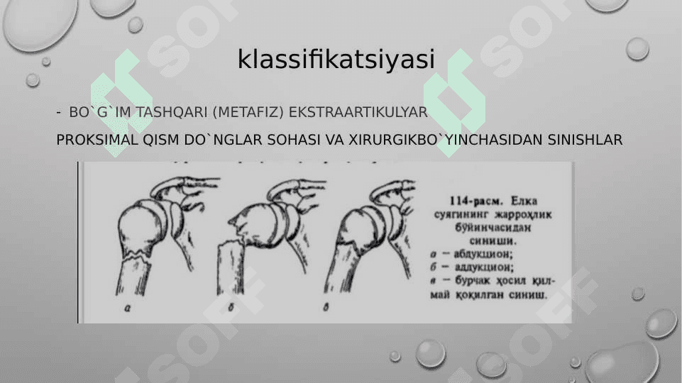 Yelka suyaklarining sinishlari va yelka suyakgi boshchasini chiqish 6