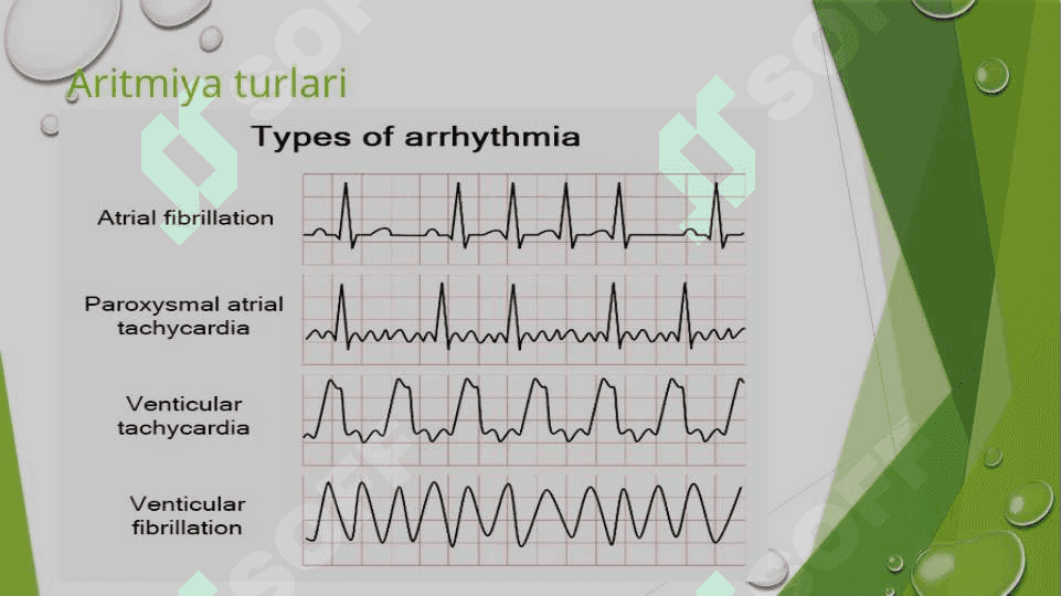 Yurak aritmiyalari EKG diagnostikasi 4