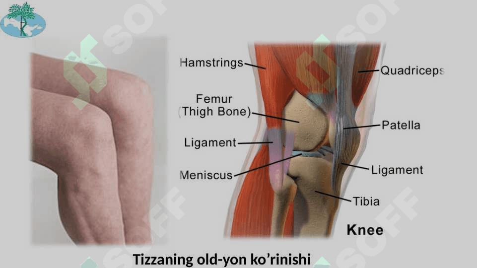 Tizza bo’g’imi shikastlanishlari 3