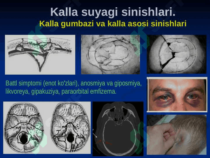 Bosh sohasi miya qismining klinik anatomiyasi 7
