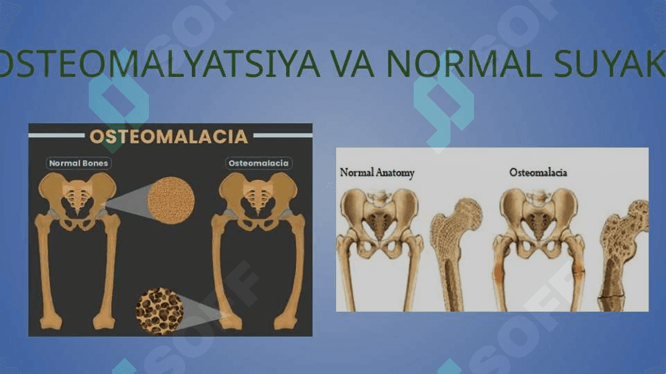 Osteomalyatsiya 3