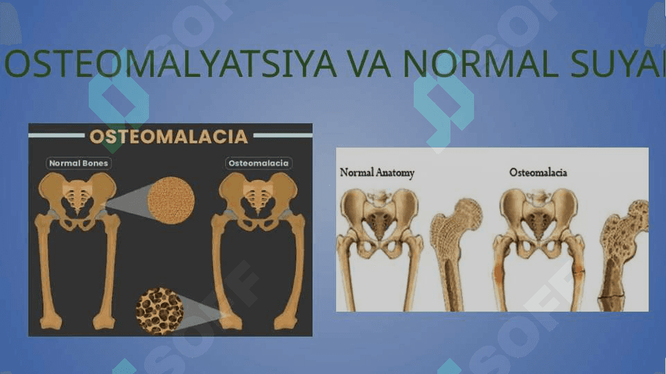 Osteomalyatsiya 3