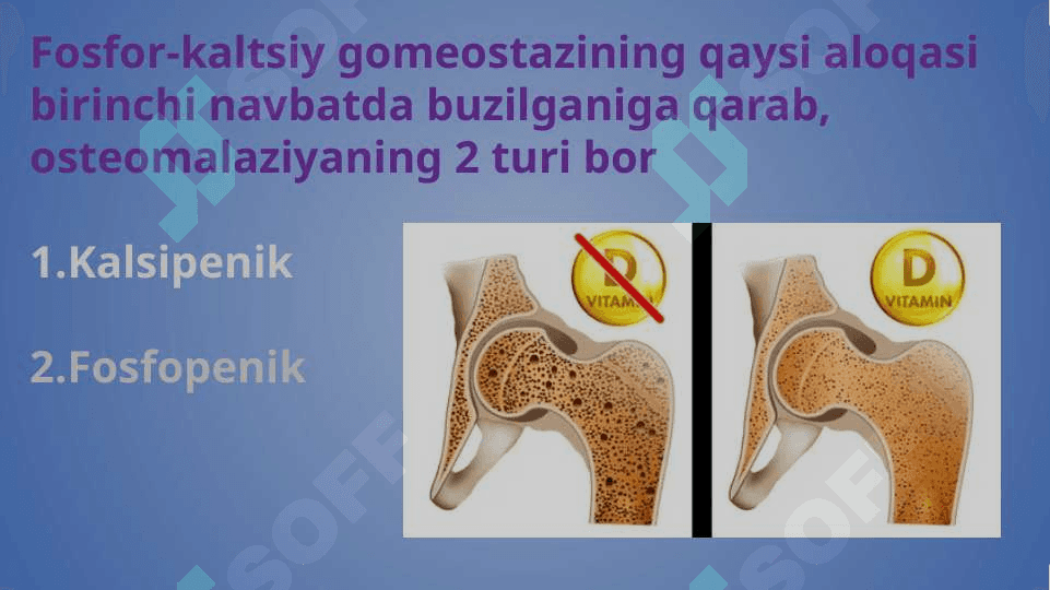Osteomalyatsiya 4
