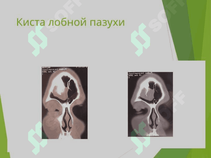 Опухоли верхних дыхательных путей и уха 6