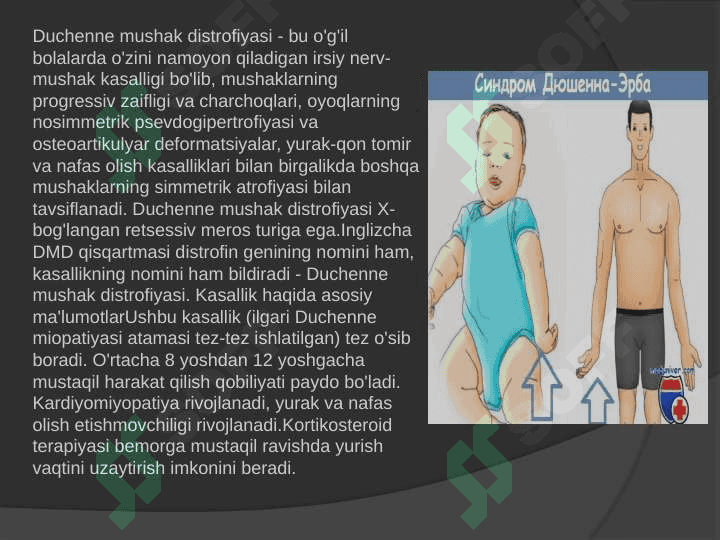 Progressiyalovchi mushak distrofiyasi .  Dyushen Sindromi .  Dushen Erba paralichi 2