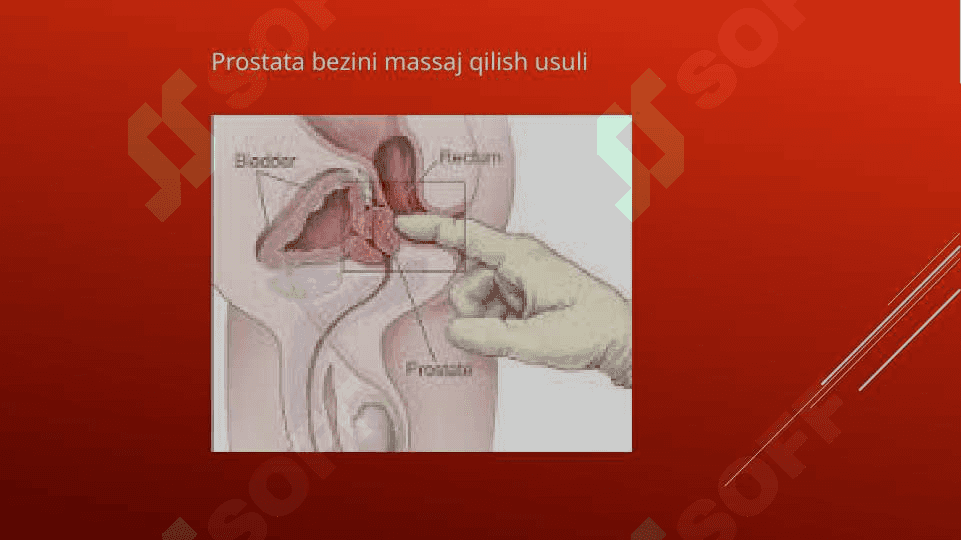 Prostata bezi adenomasi va uning yoshga bog’liq o’zgarishlari 4