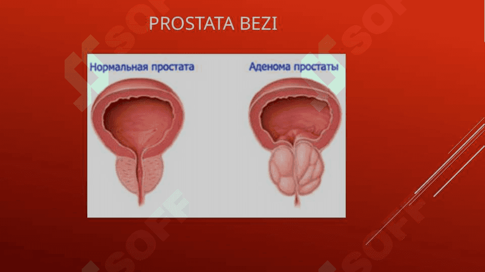 Prostata bezi adenomasi va uning yoshga bog’liq o’zgarishlari 8