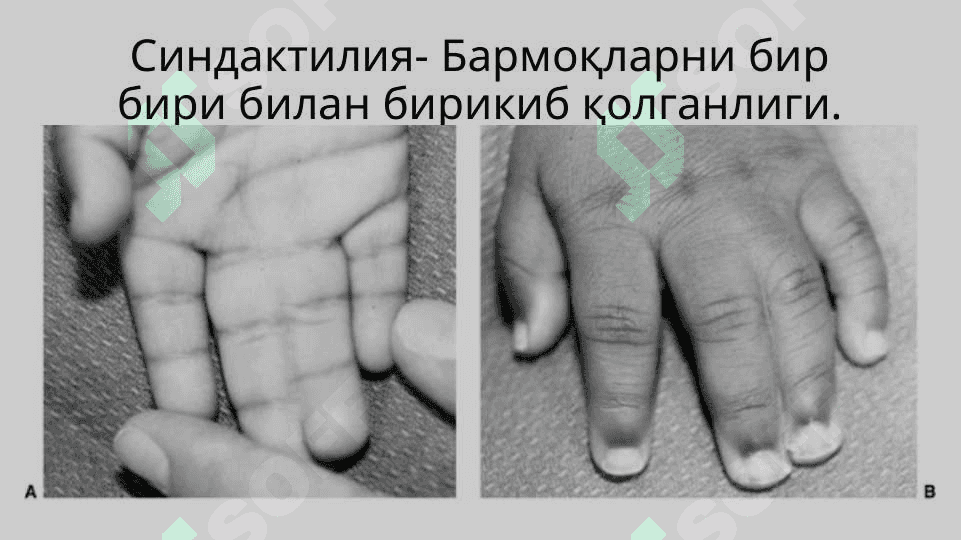 Qo`l va oyoq anomaliyalari . Қўл ва оёқ аномалиялари 5