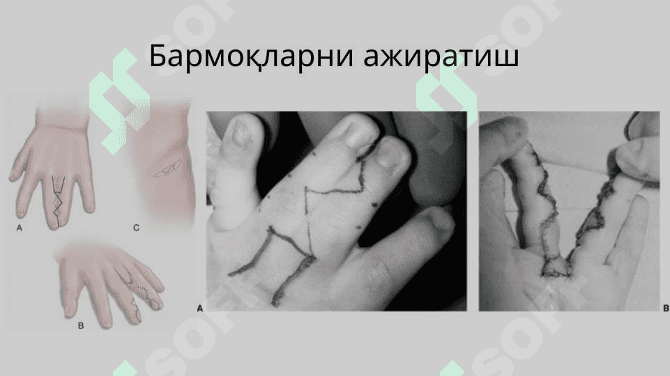 Qo`l va oyoq anomaliyalari . Қўл ва оёқ аномалиялари 6
