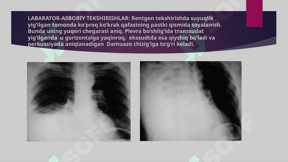 PLEVRA BO’SHLIG’IDA SUYUQLIK YIG’ILISH SINDROMI ( gidrotoraks ) 3