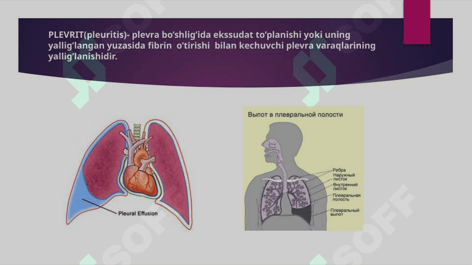 PLEVRA BO’SHLIG’IDA SUYUQLIK YIG’ILISH SINDROMI ( gidrotoraks ) 4