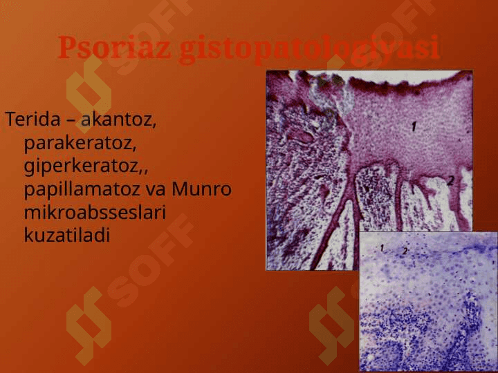 PSORIAZ vaQIZIL YASSI TEMIRATKINING ATIPIK TURLARI 4