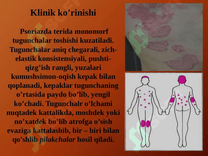 PSORIAZ vaQIZIL YASSI TEMIRATKINING ATIPIK TURLARI 5