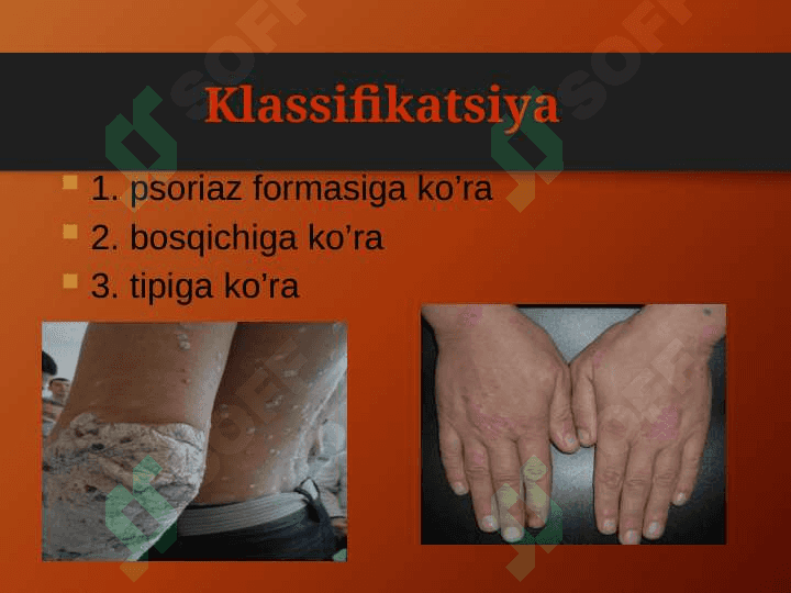 PSORIAZ vaQIZIL YASSI TEMIRATKINING ATIPIK TURLARI 6