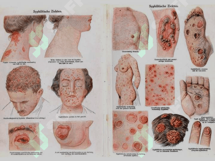 ZAXM KASALLIGI. ZAXM DIAGNOSTIKASI 3