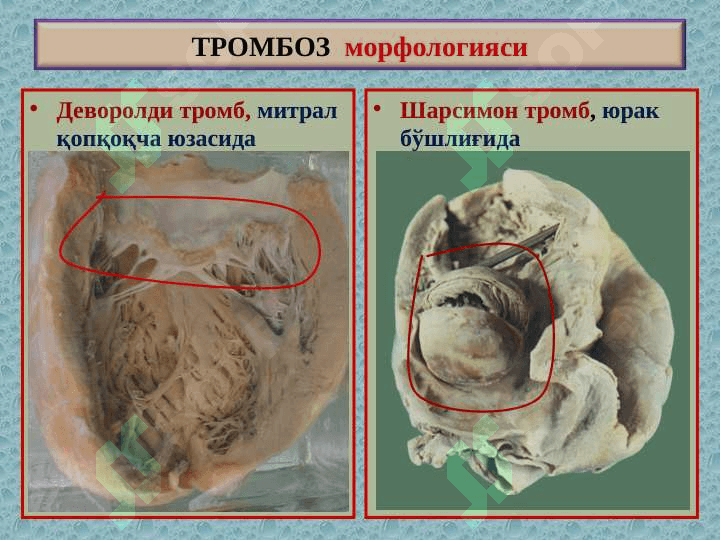 “Тромбоз. Эмболия. Стаз. Инфаркт”” 7